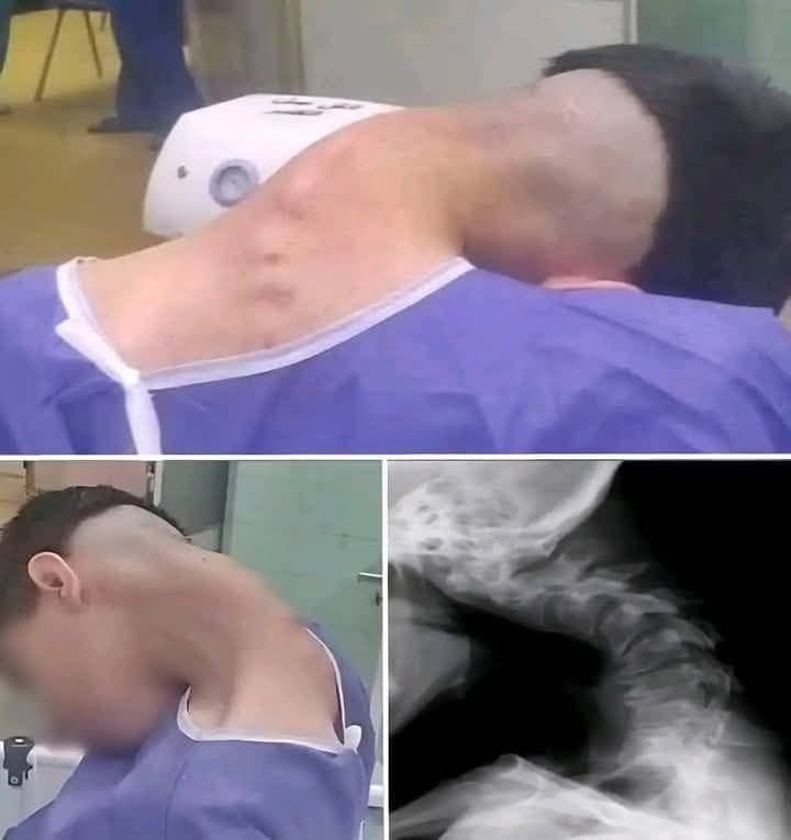 Read more about the article Young man hospitalized because he dropped his ca… See more