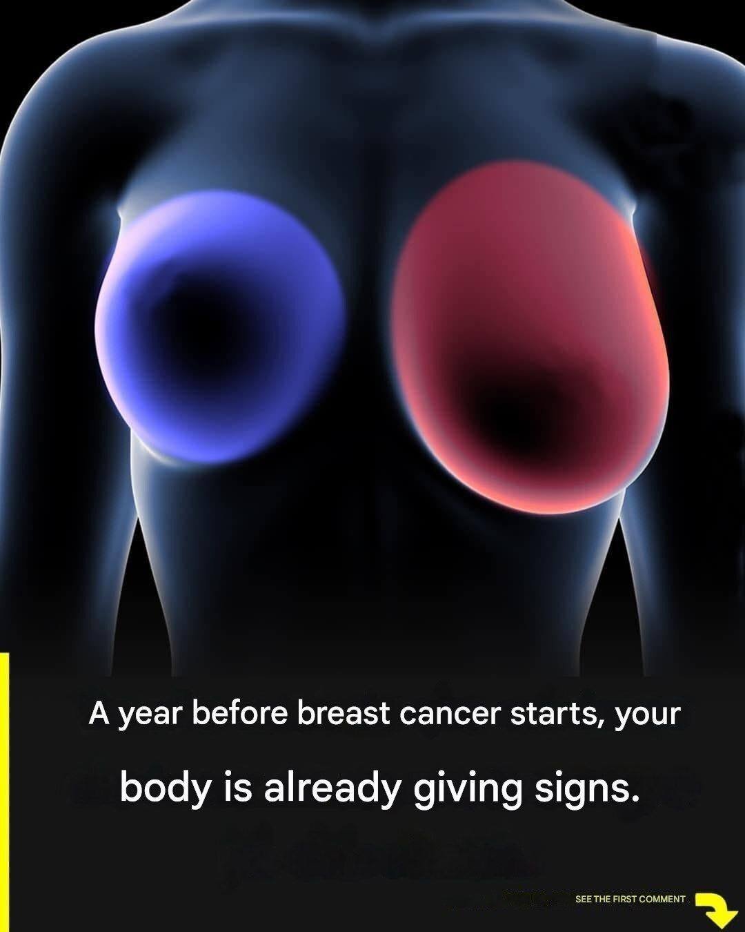 Read more about the article Breast cancer: 4 early signs every woman should know.