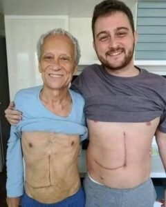Read more about the article Son who donated part of his liver to his father unfortunately ends up fa…