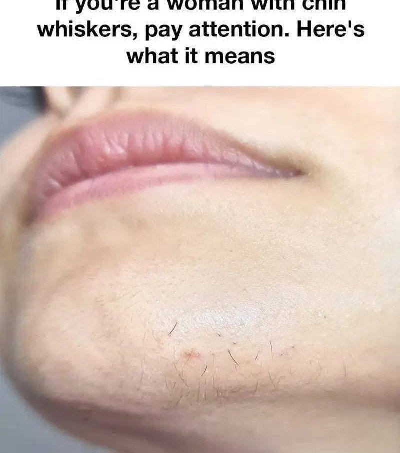 Read more about the article Chin Whiskers in Women — What’s Normal, What’s Not, and How to Navigate It Without Shame