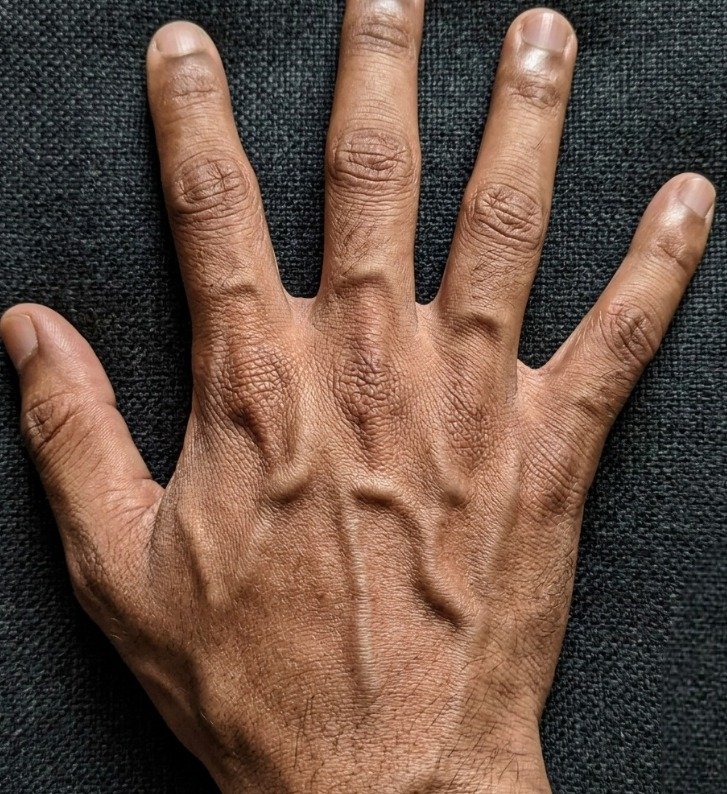 Read more about the article Visible Hand Veins Explained: Why They Appear, From Low Body Fat, Genetics, Exercise, Heat, and Hydration Changes, and When They Are Normal or Rarely a Sign of Medical Concern, Offering Reassurance That Prominent Veins Are Usually Harmless Physical Traits While Highlighting Simple Lifestyle Factors That Influence Their Appearance Over Time Naturally and safely understood today