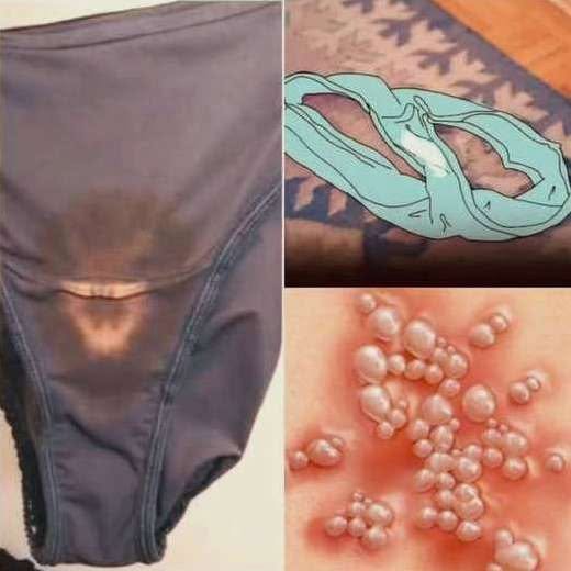 Read more about the article Why You May Notice Bleach-Like Stains on Your Underwear: Causes, Concerns, and When to See a Doctor