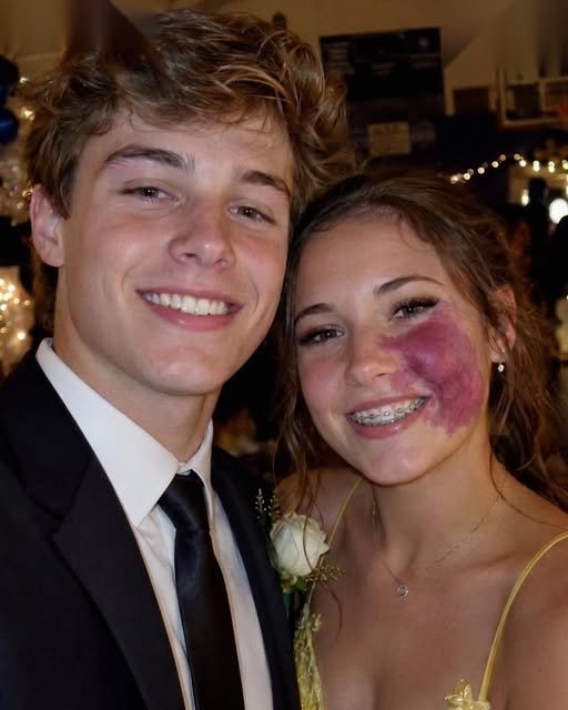 Read more about the article Only One Boy Asked Me to Prom Because No One Else Wanted to Due to the Birthmark on My Face – Everyone Laughed Until an Officer Walked Into the Hall