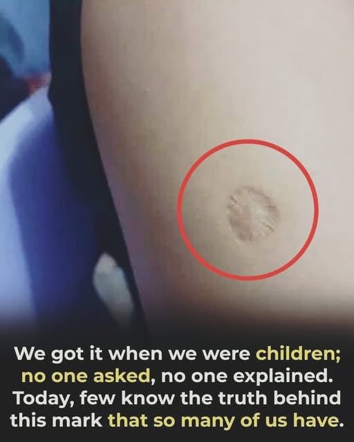 Read more about the article What the small round scar on your arm might indicate