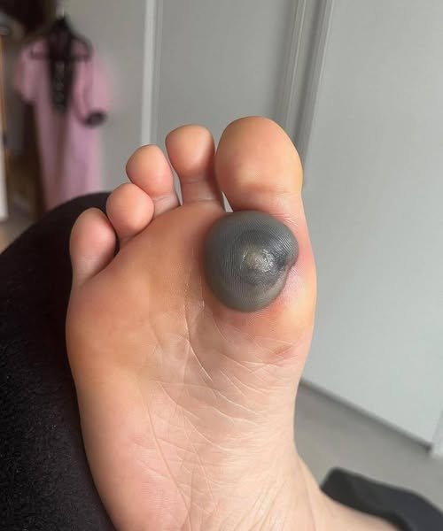 Read more about the article My daughter woke up with this huge spot on her foot I don’t know what it could be. She’s been in pain and can’t move her foot what is this.. Explain this