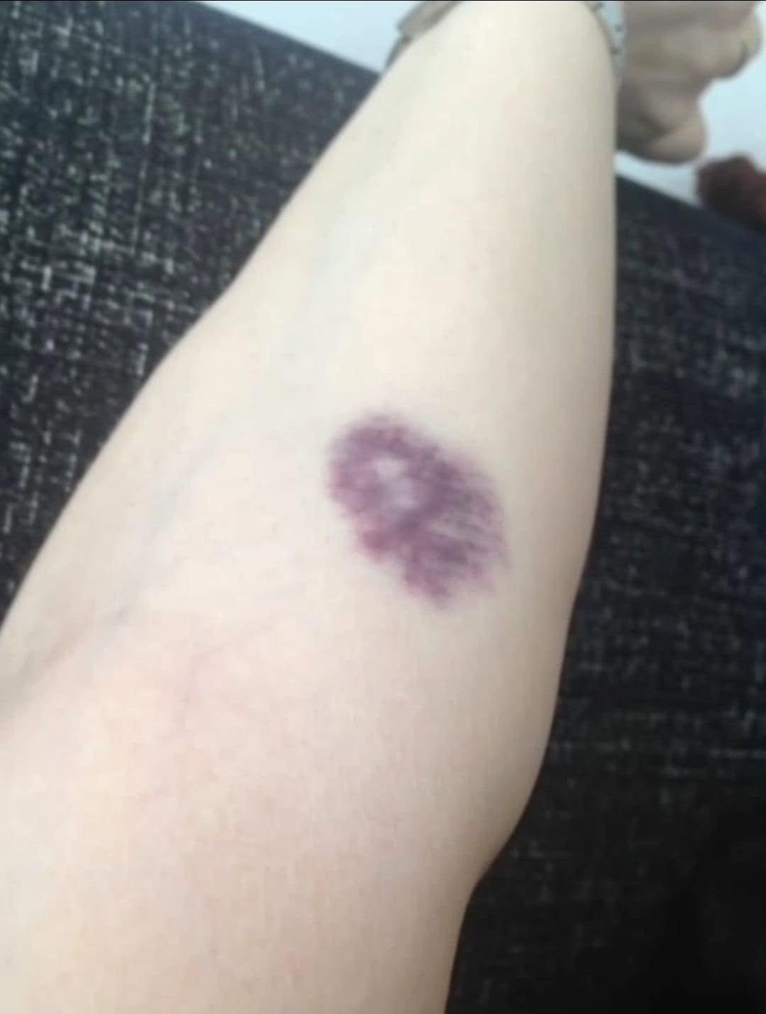 Read more about the article BE CAREFUL, if you get these bruises on your body, it means you have Ca…see more