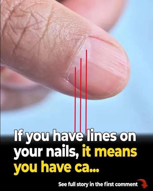 Read more about the article Doctor reveals health issues hidden in your nails