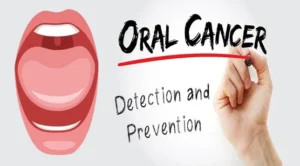 Read more about the article Oral Cancer: Causes, Symptoms, Diagnosis, Treatment and Prevention