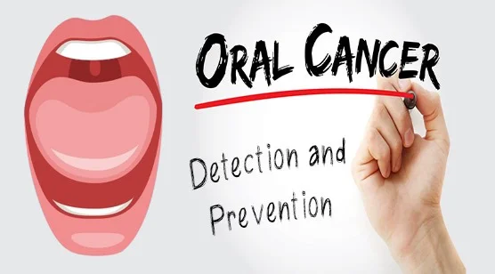 Read more about the article Oral Cancer: Causes, Symptoms, Diagnosis, Treatment and Prevention