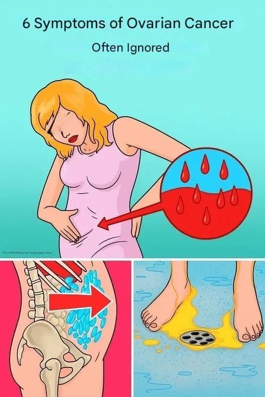 Read more about the article Ovarian Cancer: 6 Warning Signs You Shouldn’t Ignore